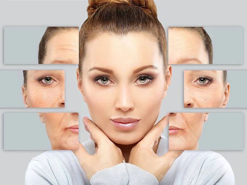 اندولیفت نخ (3)