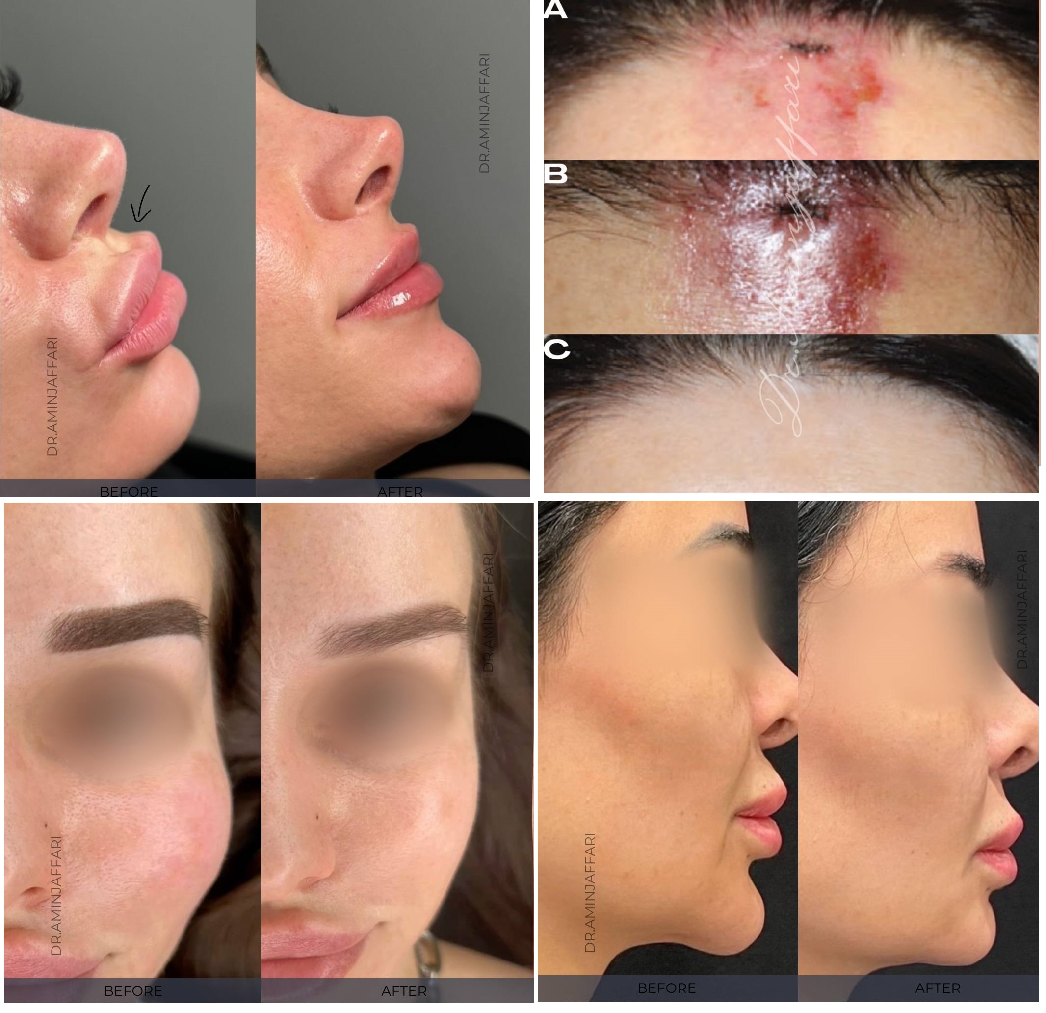 تخلیه ژل اجزای صورت دکتر امین جعفری