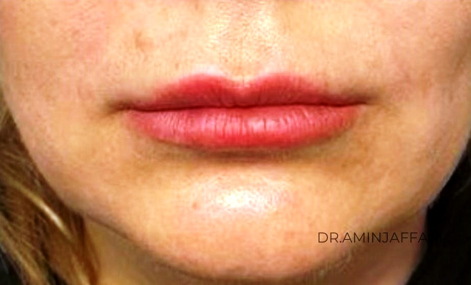 تخلیه ژل دکتر امین جعفری (17)