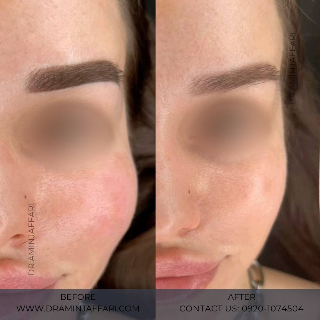 تخلیه ژل صورت (4)