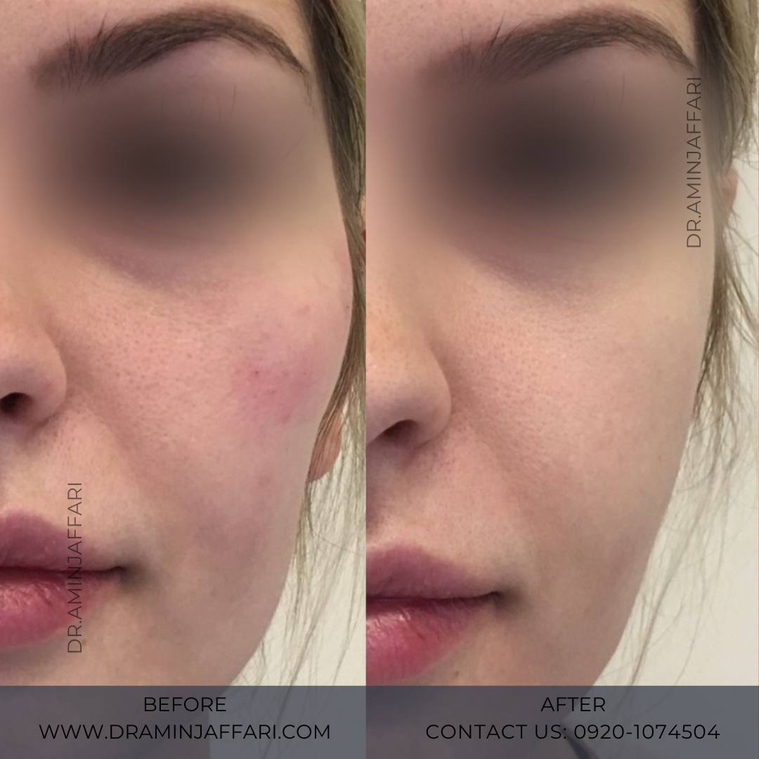 مزایای ریمادلینگ لب