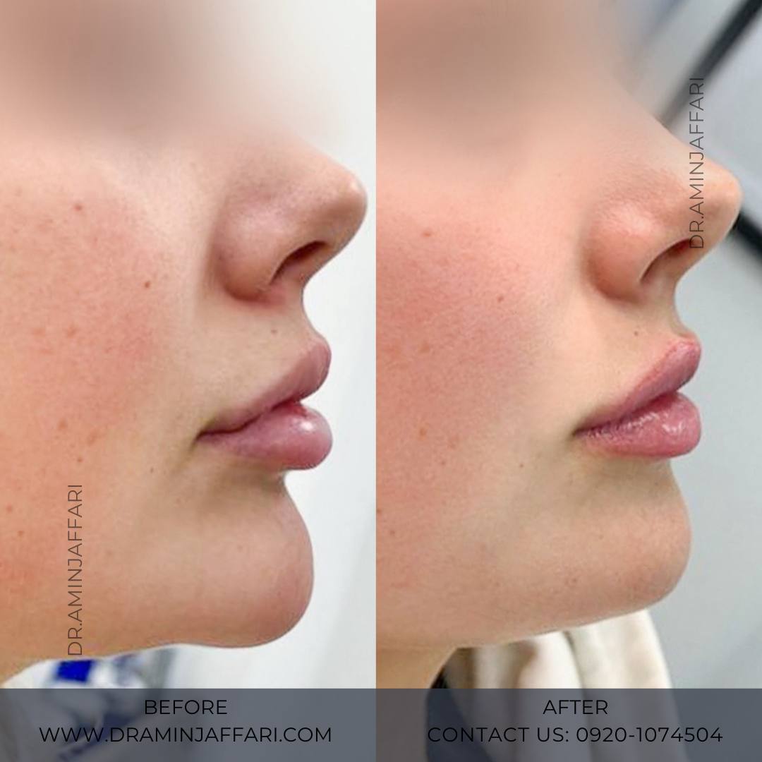 فرآیند ریمادلینگ لب