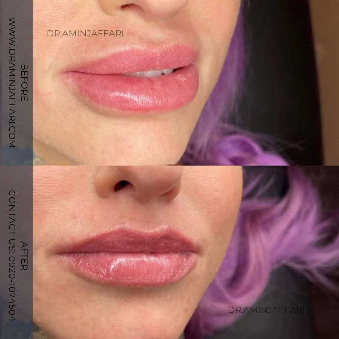 تخلیه ژل لب دکتر امین جعفری (1)