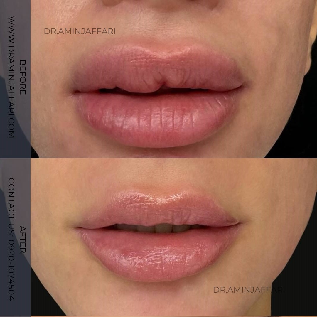 تخلیه ژل لب دکتر امین جعفری (10)