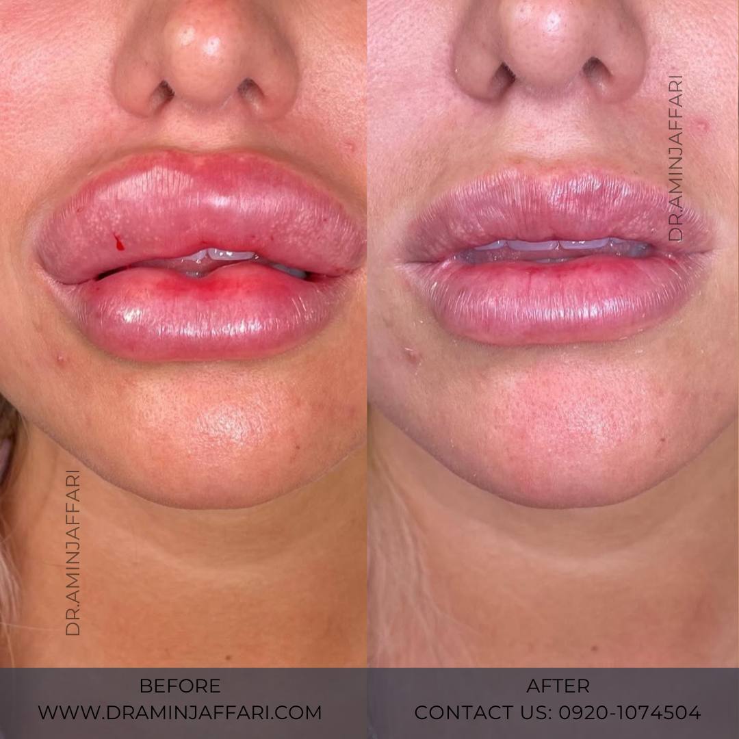 تخلیه ژل لب