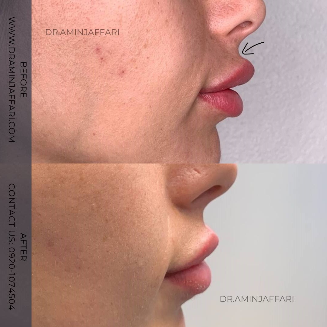 تخلیه ژل لب دکتر امین جعفری (2)