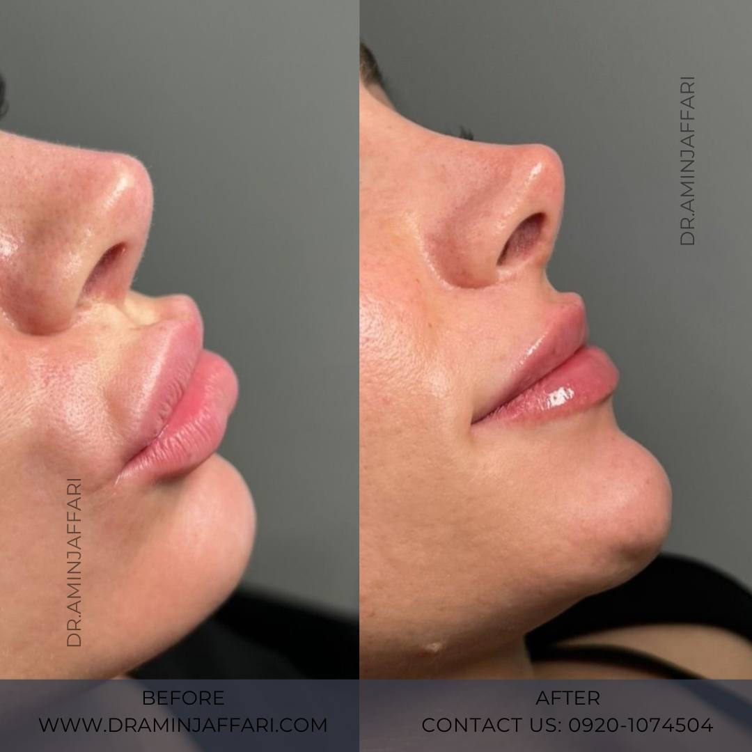 تخلیه ژل لب