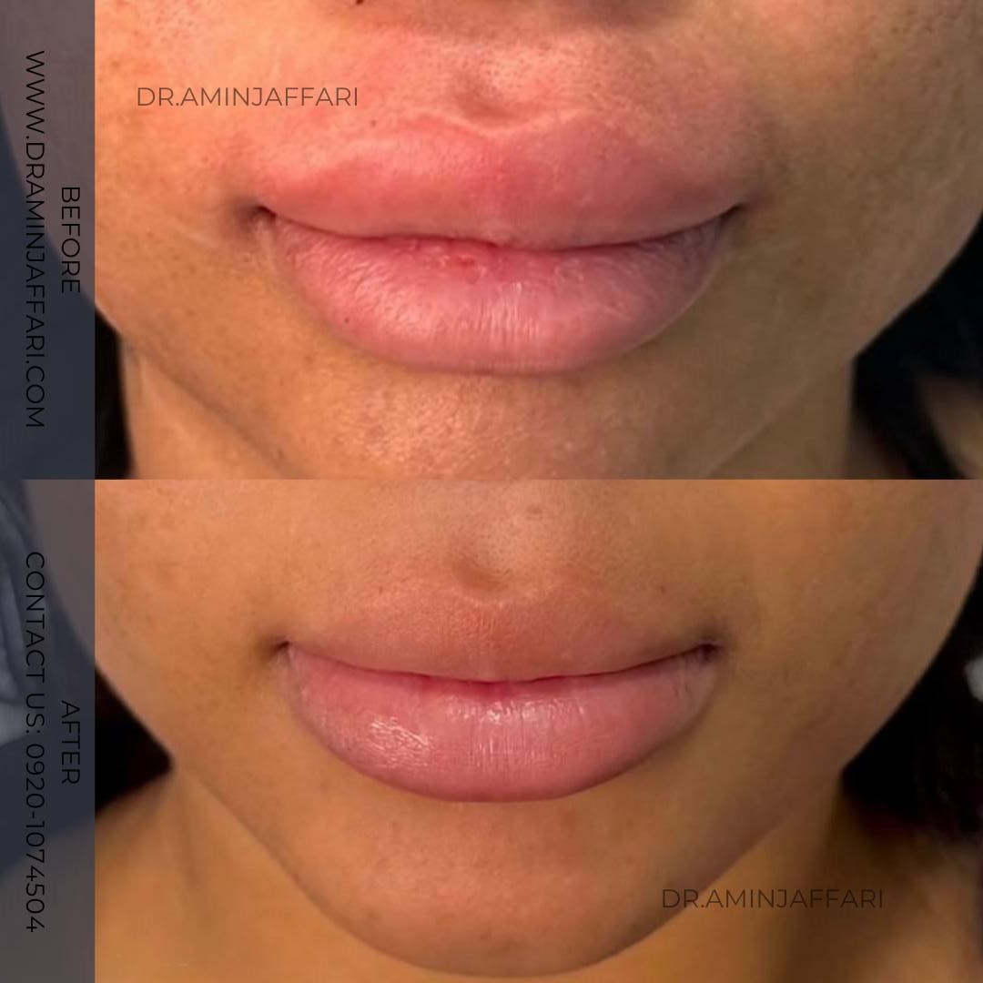 تخلیه ژل لب دکتر امین جعفری (4)