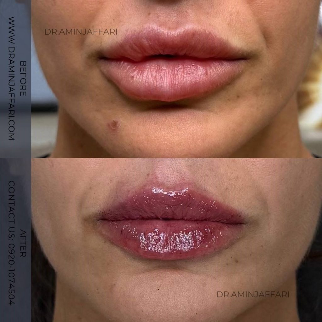 تخلیه ژل لب دکتر امین جعفری (5)