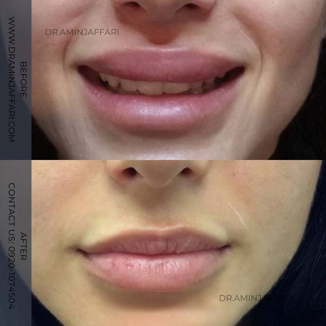 تخلیه ژل لب دکتر امین جعفری (8)