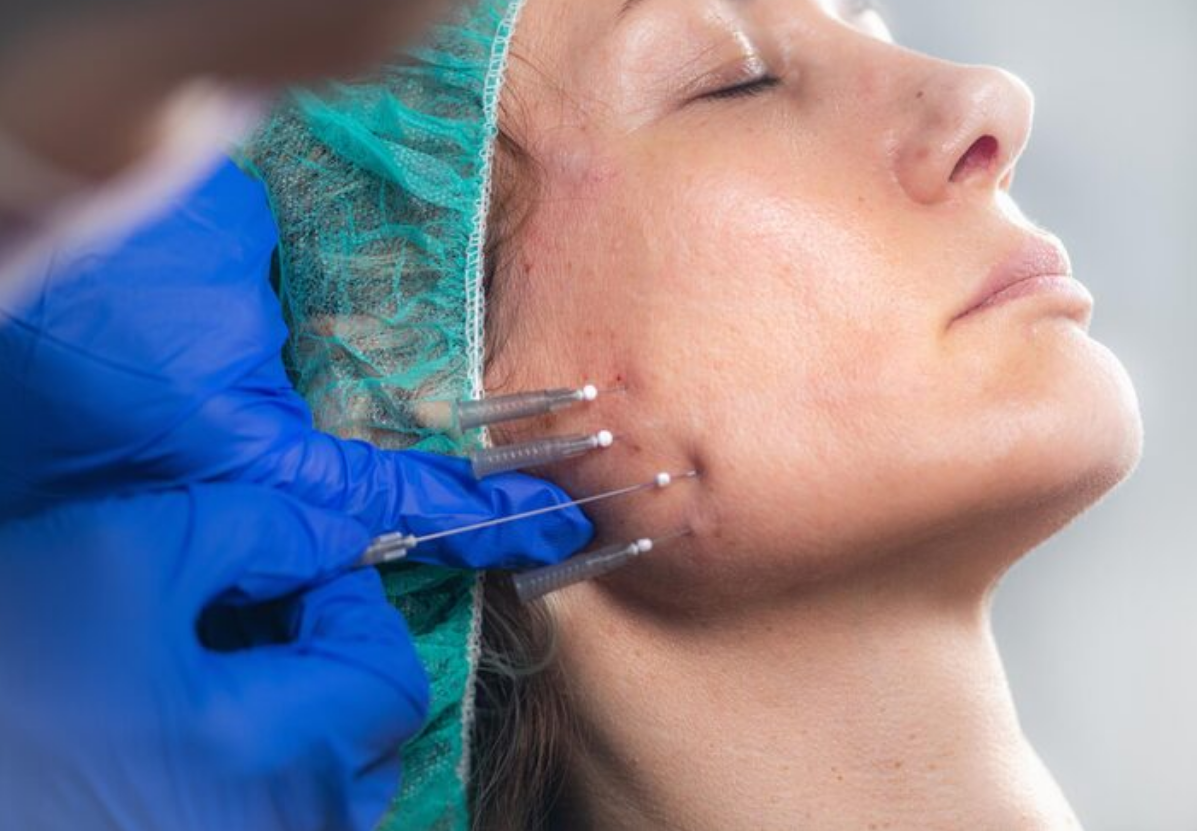 تخلیه نخ لیفت صورت بدون جراحی