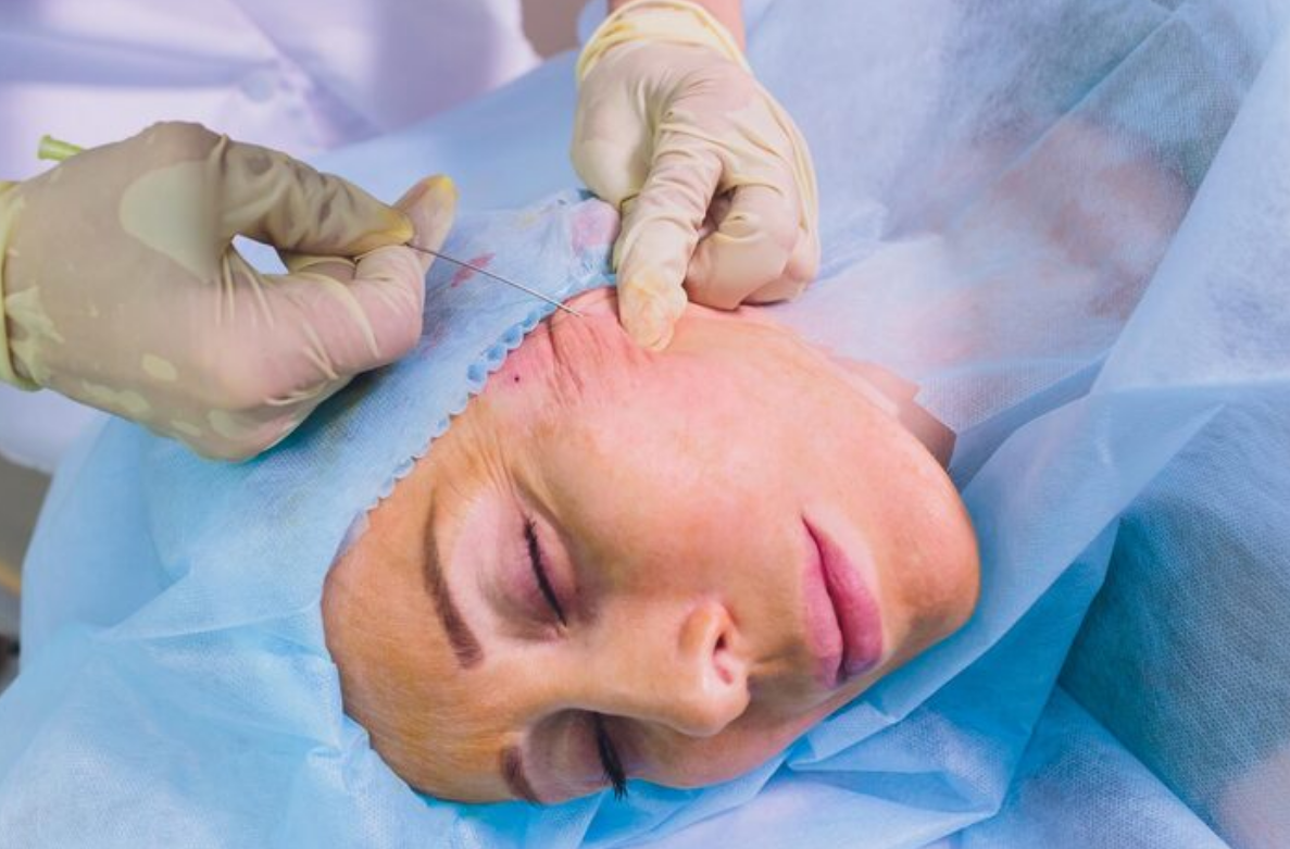 مراقبت بعد از تخلیه نخ لیفت