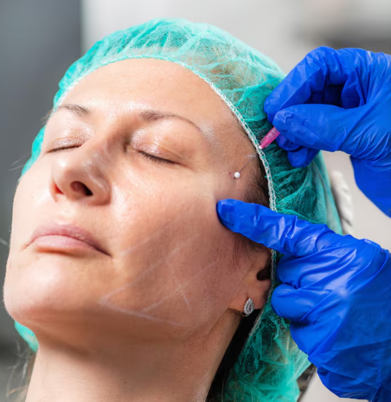 خارج سازی انواع نخ ( لیفت، امبدینگ)