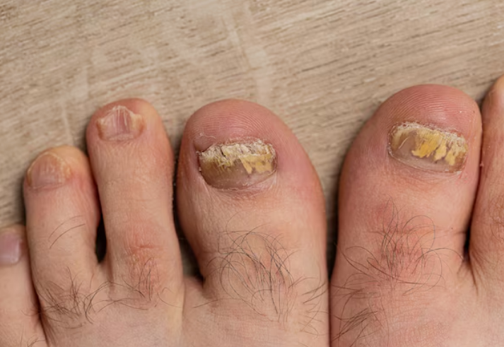 بازسازی ناخن بعد از جراحی