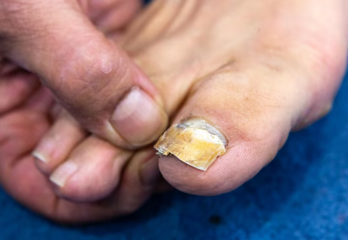 درمان بیمارهای ناخن