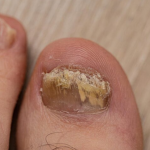 درمان بیمارهای ناخن1