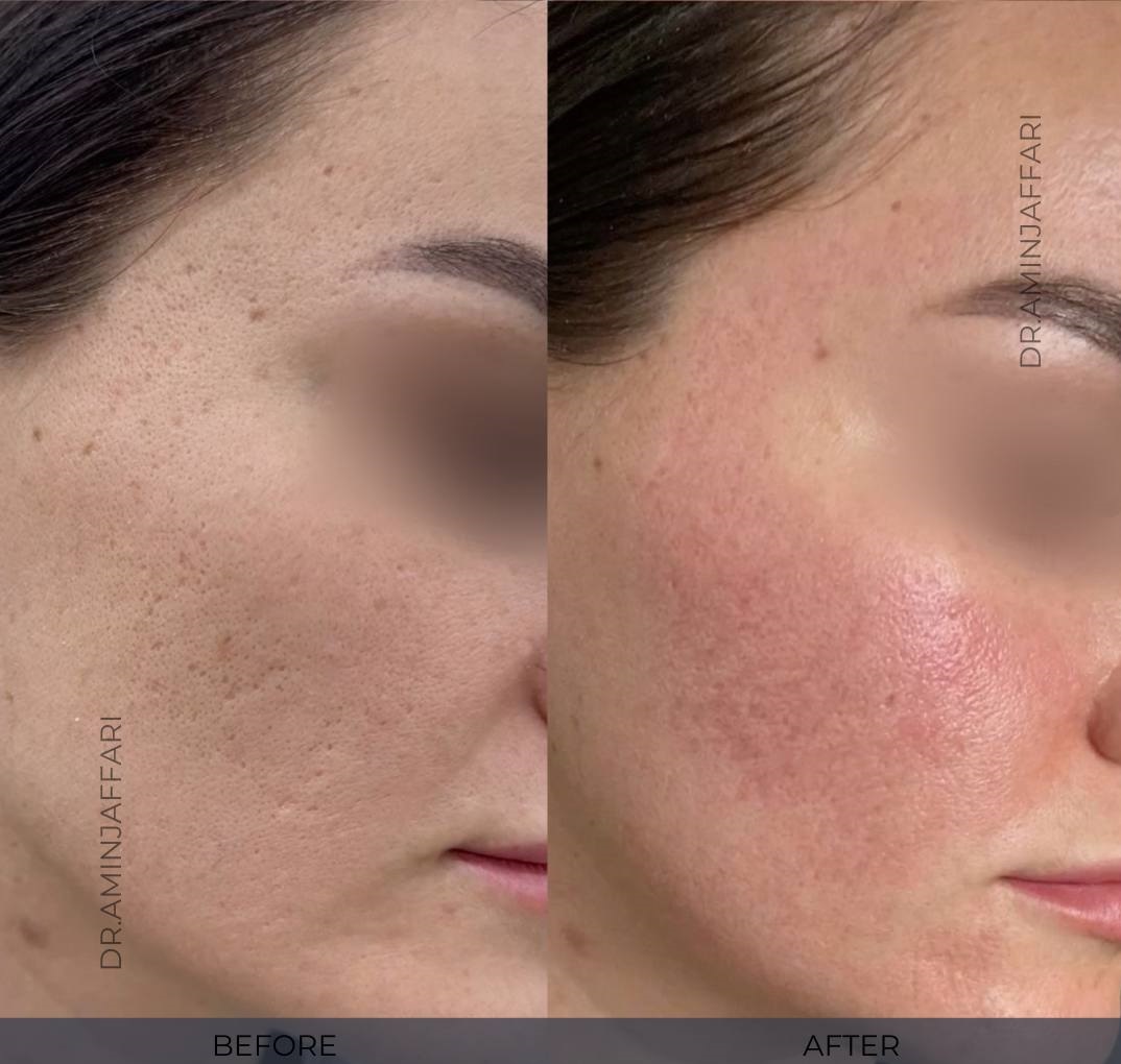 درمان جای جوش و لک -دکتر امین جعفری (2)