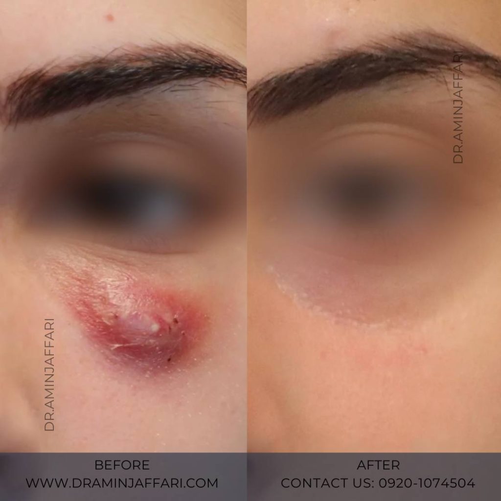 نکروز پوست چیست؟ نشانه‌ها، علت‌ها و راه‌های تشخیص سریع | دکتر امین جعفری