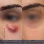 درمان نکروز (1)