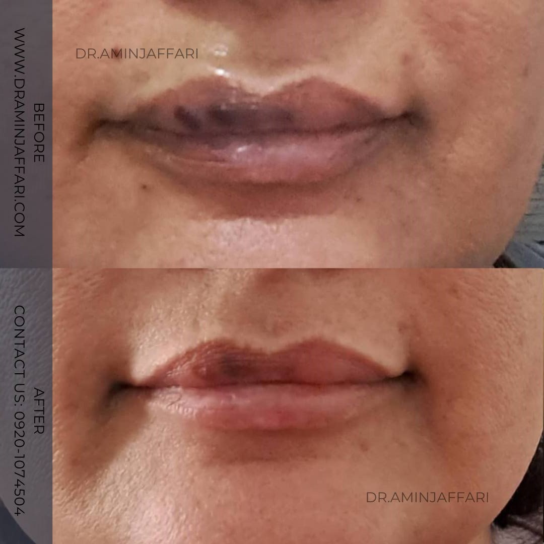 ترمیم نکروز ناشی از تزریق ژل