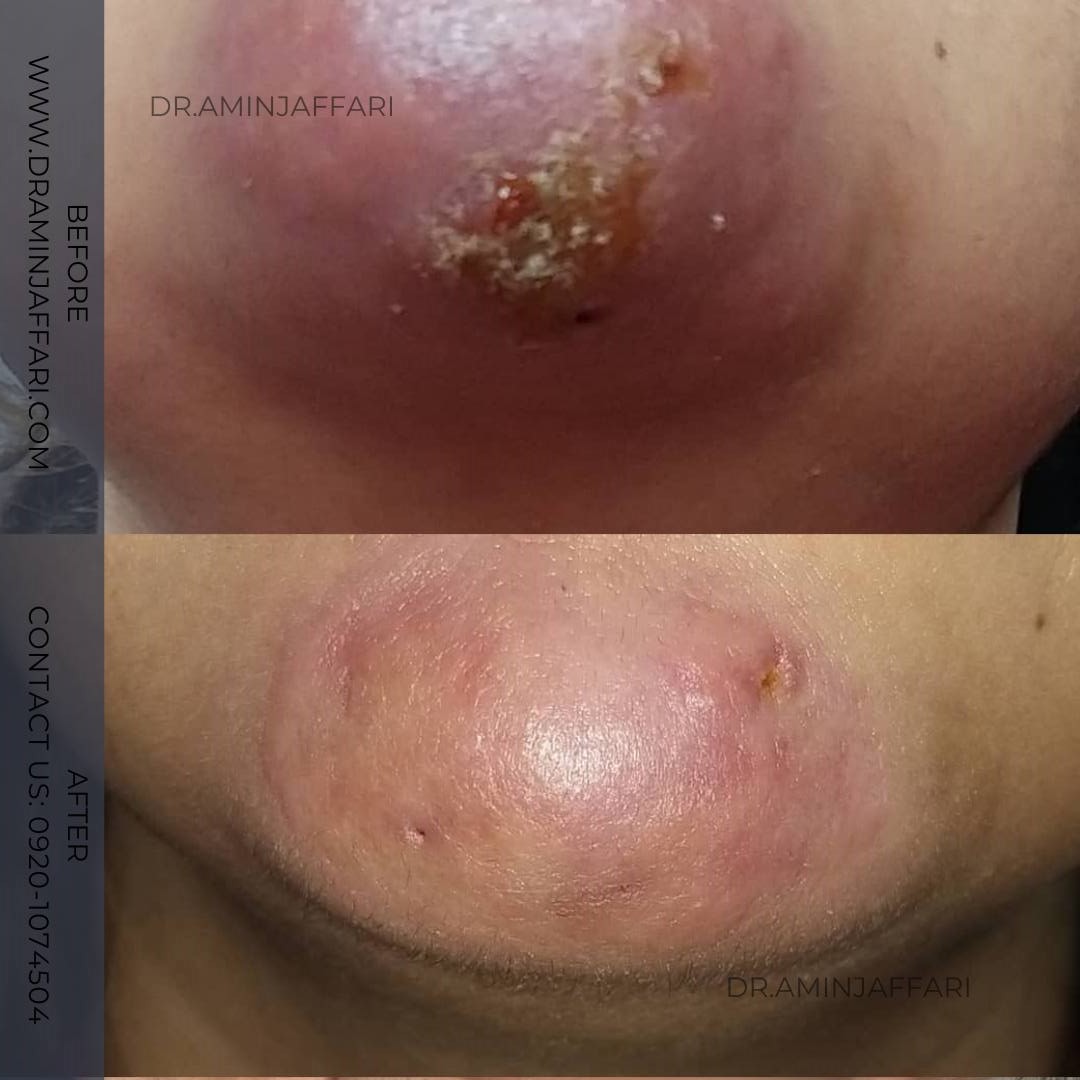 بازسازی پوست پس از نکروز