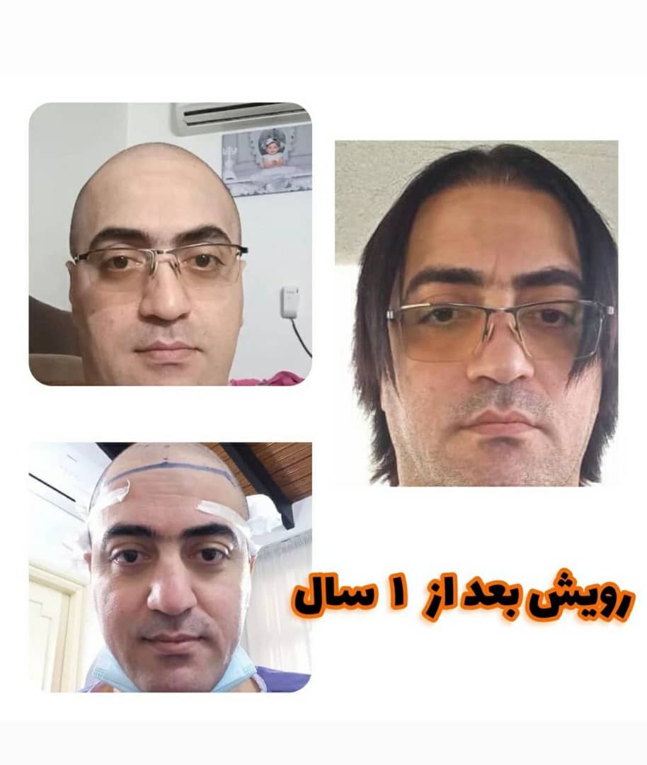 طراحی کاشت ابرو دکتر جعفری