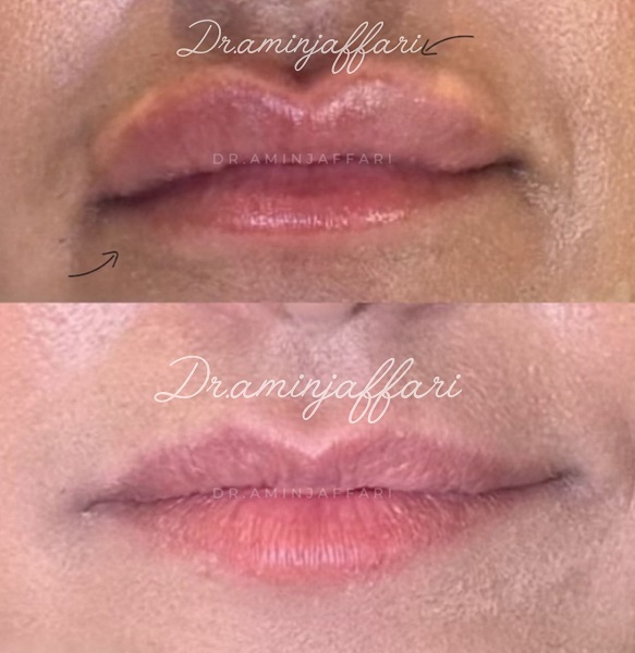 ۴ مرحله مهم برای تخلیه ژل و لیفت طبیعی صورت