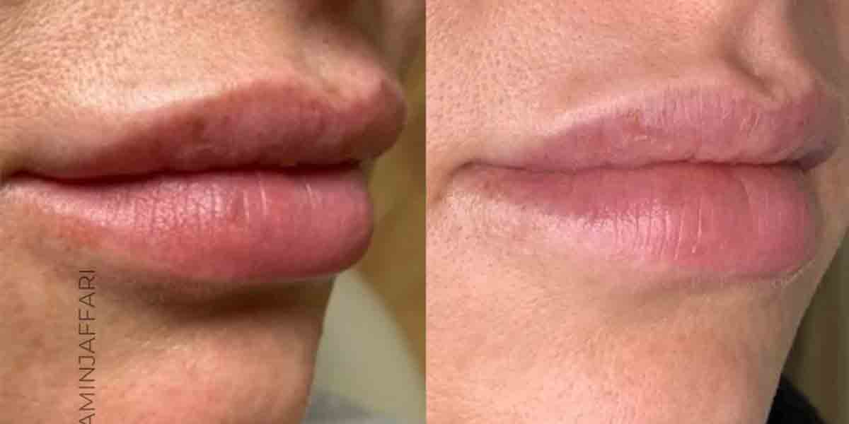 تخلیه ژل بدون جراحی با روش آندوسکوپیک