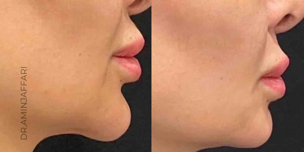 تخلیه ژل بدون جراحی با روش آندوسکوپیک