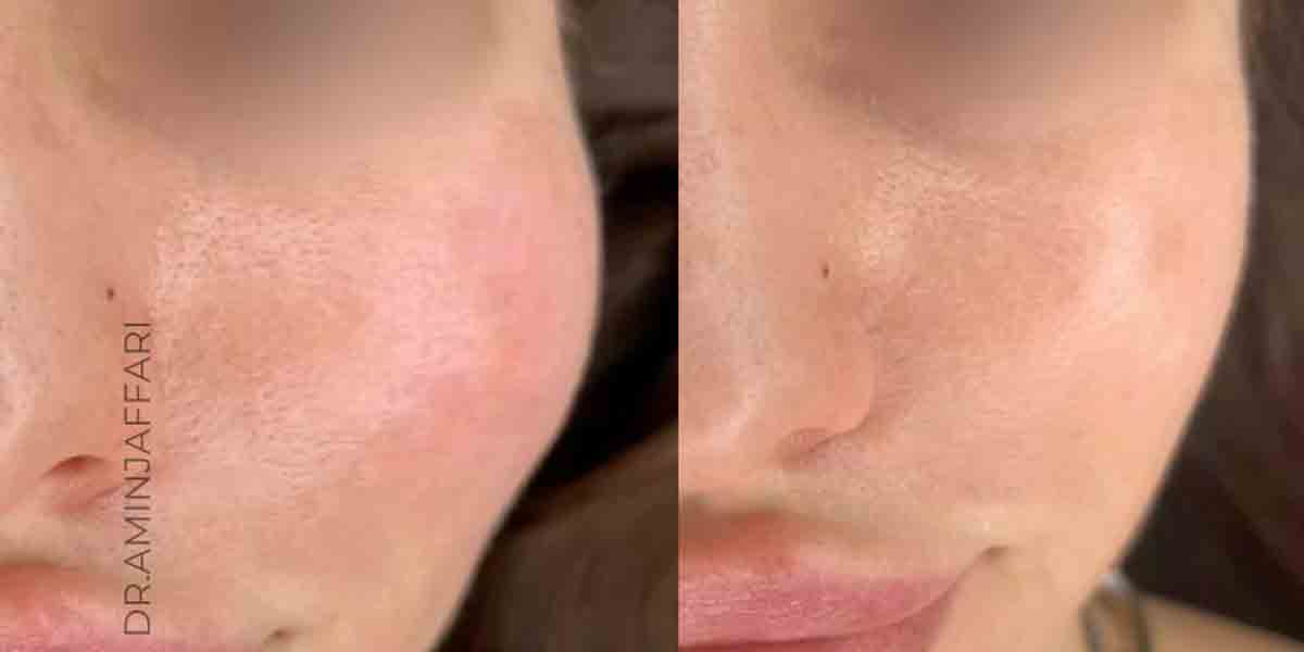 تخلیه ژل بدون جراحی با روش آندوسکوپیک