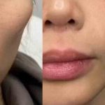 تخلیه ژل بدون جراحی با روش آندوسکوپیک