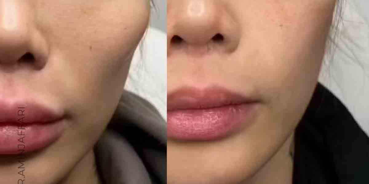 تخلیه ژل بدون جراحی با روش آندوسکوپیک