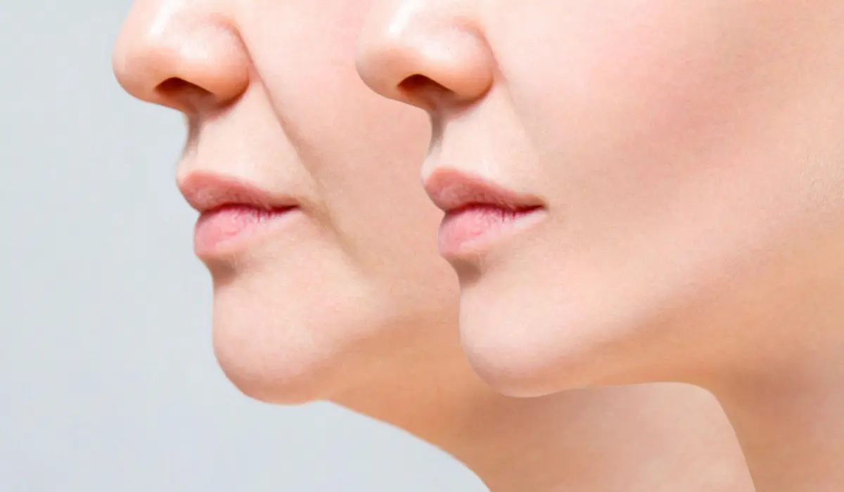 لیپوفیس چیست؟ کانتورینگ صورت‌ بدون اغراق