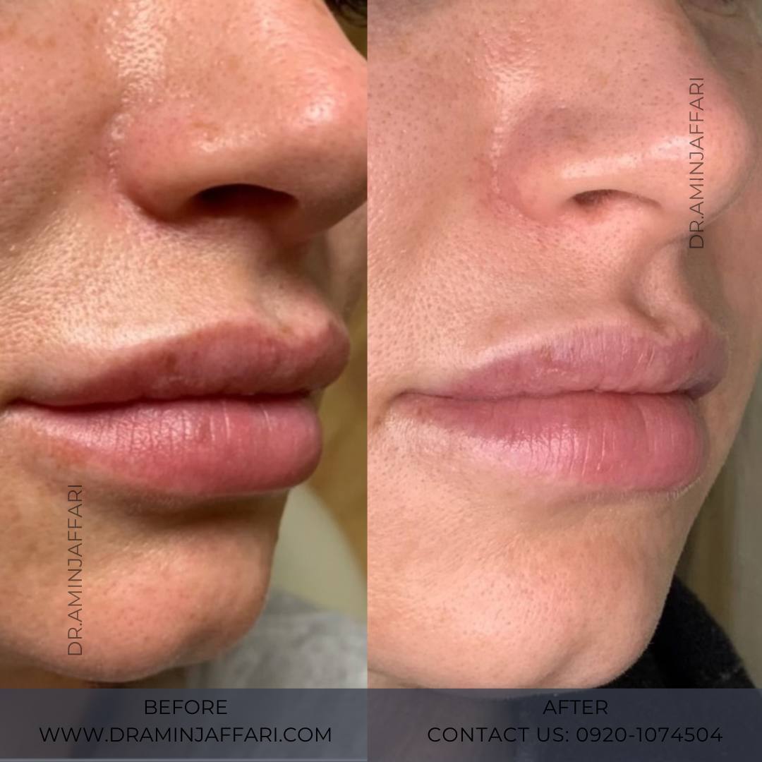 تخلیه ژل لب