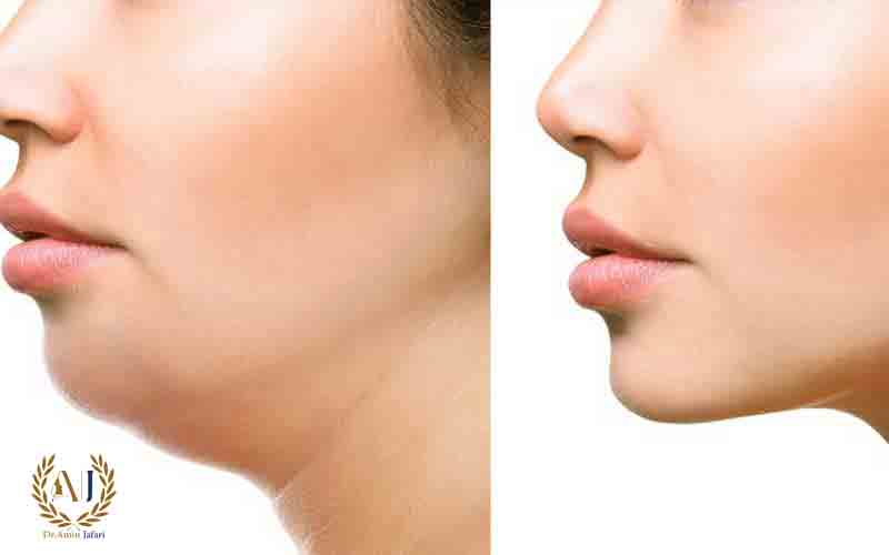 لیپوفیس چیست و چرا انتخابی هوشمندانه است؟