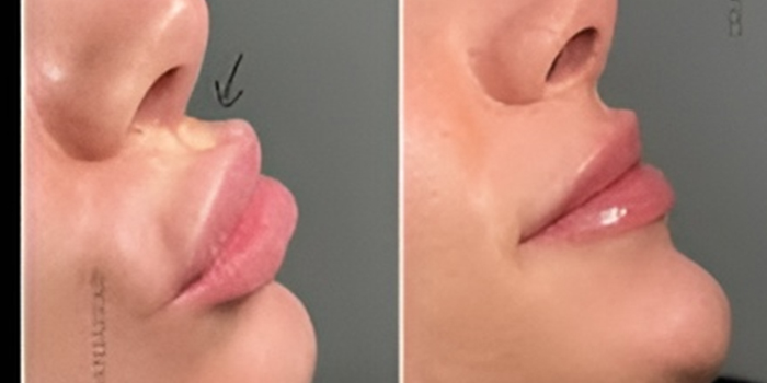 تخلیه ژل پاژ در گونه، لب و چانه چگونه انجام می‌شود؟