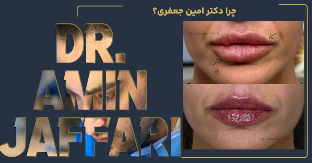 تخلیه ژل دکتر امین جعفری .