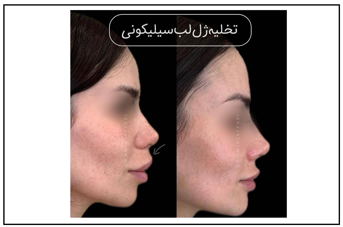 ژل لب سیلیکونی چیست