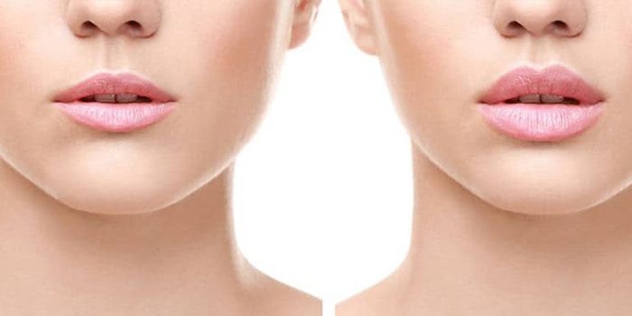 تخلیه ژل گونه ؛ چرا بعضی صورت ها طبیعی ترمی شوند؟