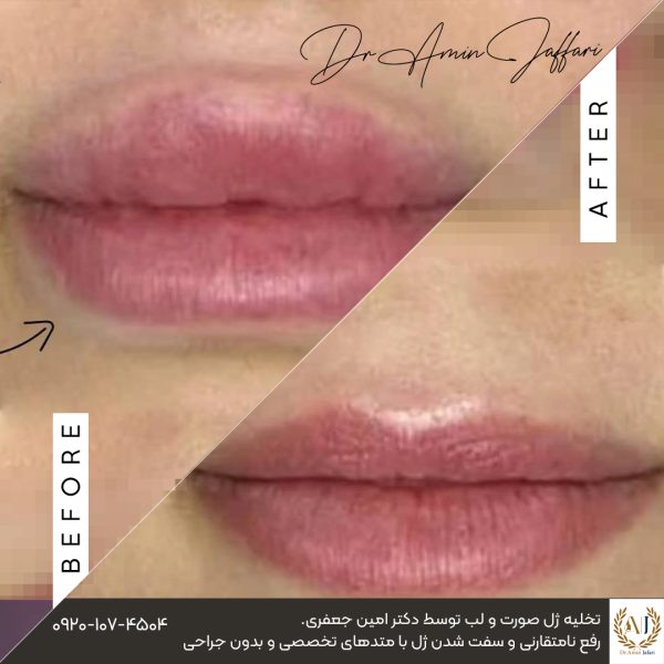 قبل و بعد تخلیه ژل دکتر امین جعفری 10