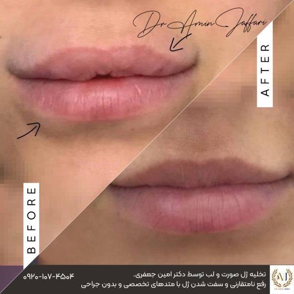 تخلیه ژل پاژ در گونه، لب و چانه چگونه انجام می‌شود؟